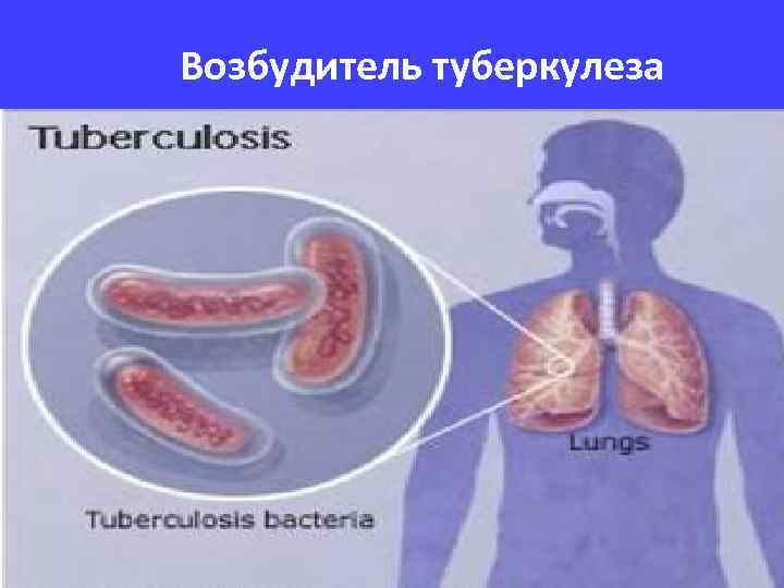 Возбудитель туберкулеза 