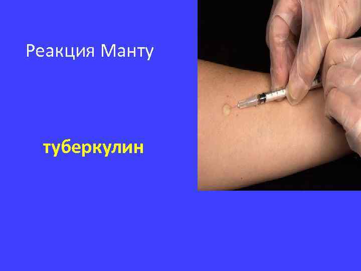 Реакция Манту туберкулин 