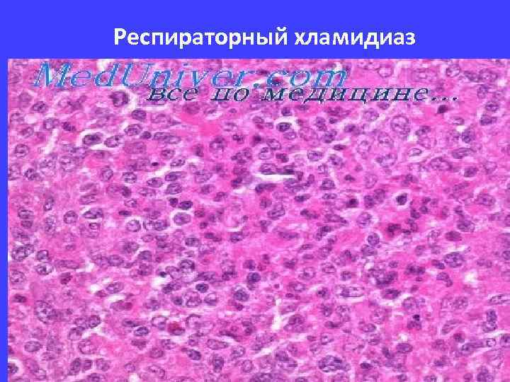 Респираторный хламидиаз 