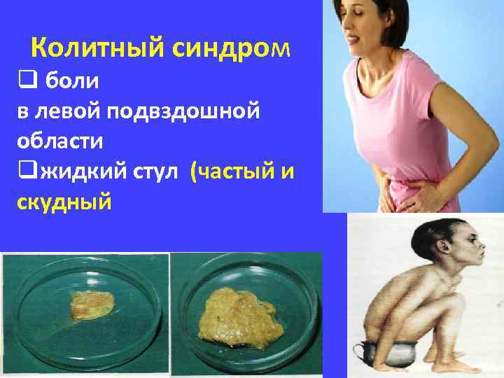 Колитный синдром q боли в левой подвздошной области qжидкий стул (частый и скудный 