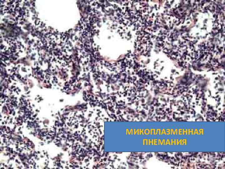 МИКОПЛАЗМЕННАЯ ПНЕМАНИЯ 