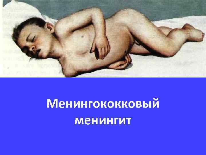 Менингококковый менингит 