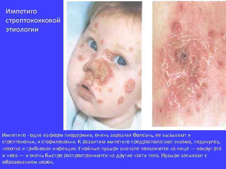 Импетиго стрептококковой этиологии Импетиго - одна из форм пиодермии, очень заразная болезнь, ее вызывают