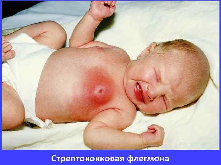 Стрептококковая флегмона 
