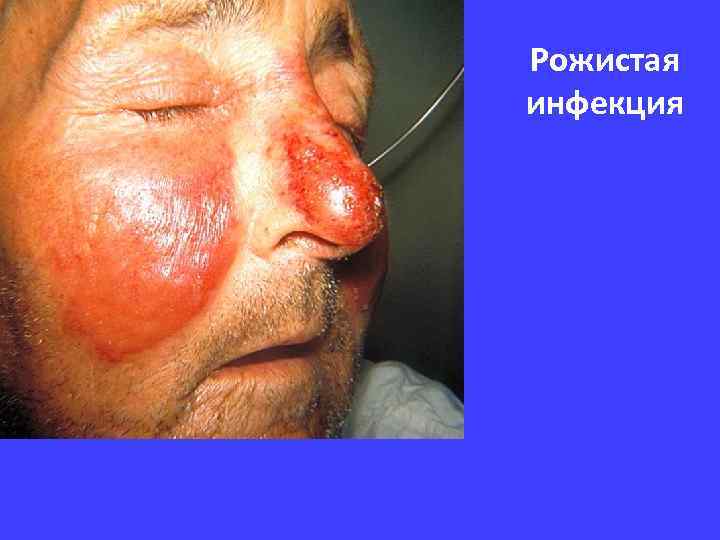 Рожистая инфекция 
