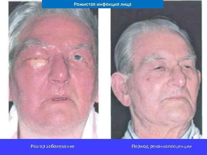 Рожистая инфекция лица Разгар заболевания Период реконвалесценции 