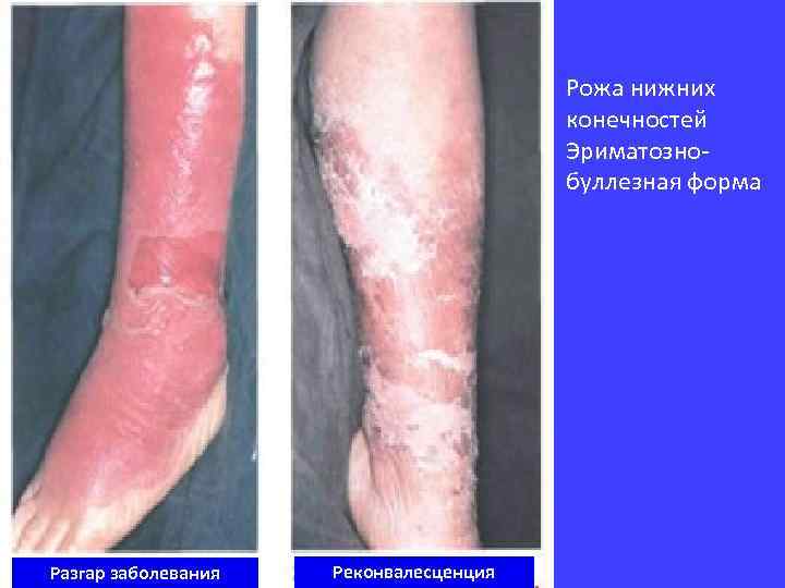 Рожа нижних конечностей Эриматознобуллезная форма Разгар заболевания Реконвалесценция 