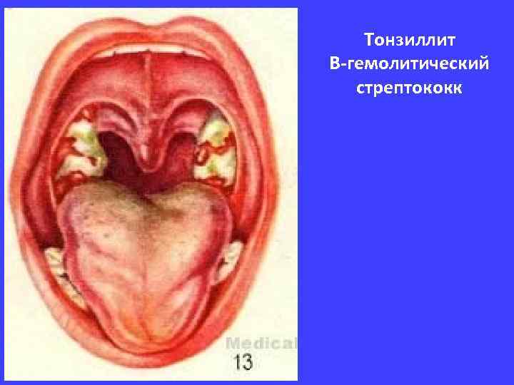 Тонзиллит В-гемолитический стрептококк 