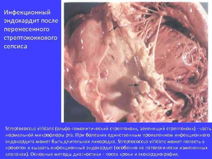 Инфекционный эндокардит после перенесенного стрептококкового сепсиса Streptococcus viridans (альфа-гемолитический стрептококк, зеленящий стрептококк) - часть