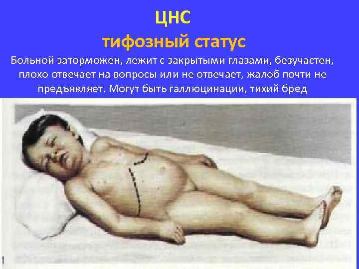 ЦНС тифозный статус Больной заторможен, лежит с закрытыми глазами, безучастен, плохо отвечает на вопросы