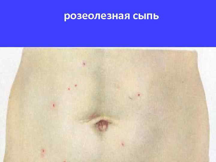 розеолезная сыпь 