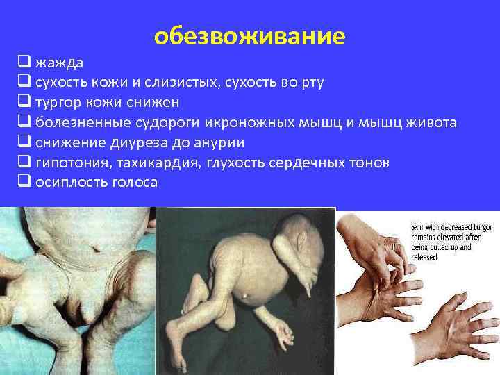 обезвоживание q жажда q сухость кожи и слизистых, сухость во рту q тургор кожи