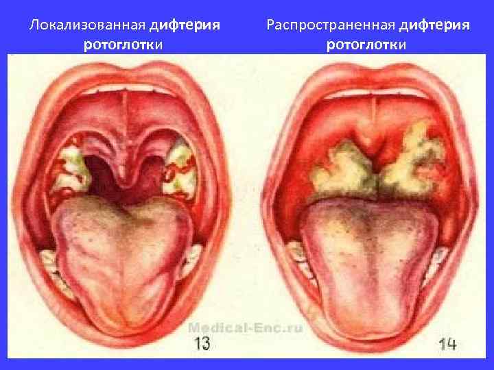  Локализованная дифтерия ротоглотки Распространенная дифтерия ротоглотки 