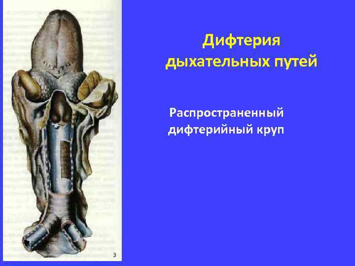 Дифтерия дыхательных путей Распространенный дифтерийный круп 