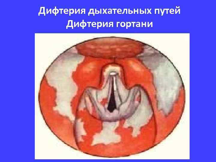 Дифтерия дыхательных путей Дифтерия гортани 