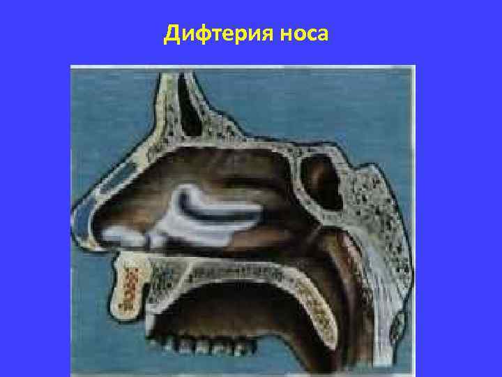 Дифтерия носа 