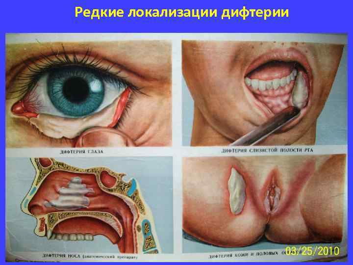 Редкие локализации дифтерии 