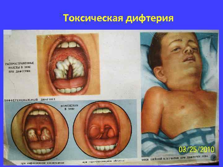 Токсическая дифтерия 