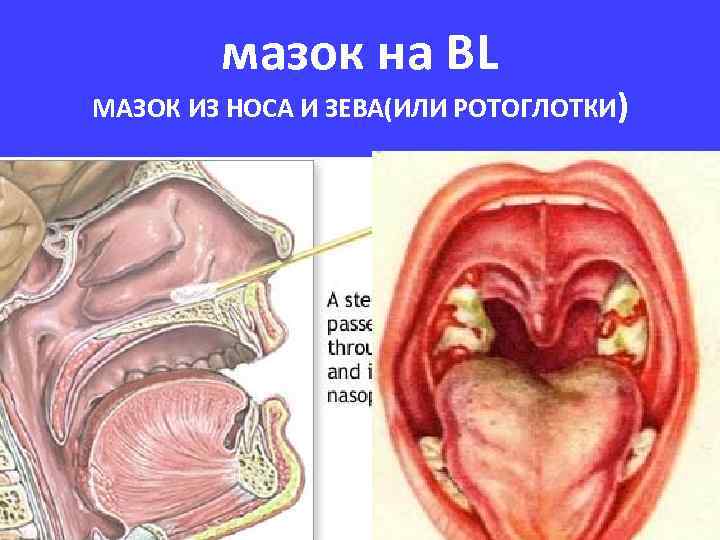 мазок на ВL МАЗОК ИЗ НОСА И ЗЕВА(ИЛИ РОТОГЛОТКИ) 