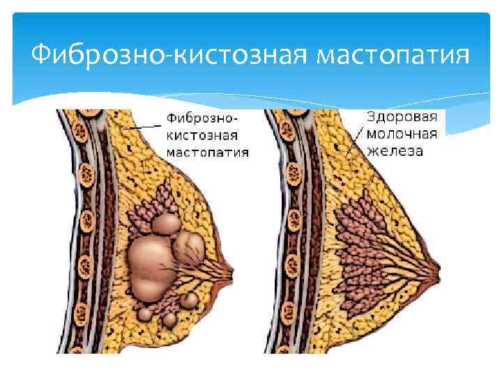 Фиброзно-кистозная мастопатия 