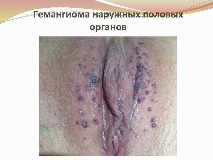 Гемангиома наружных половых органов 