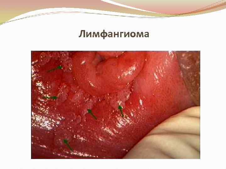 Лимфангиома 