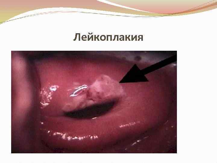 Лейкоплакия 