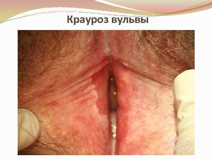 Крауроз вульвы 