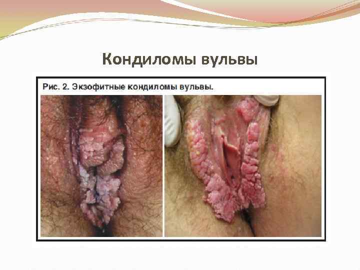 Кондиломы вульвы 