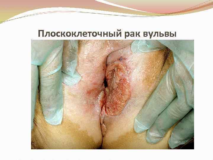 Плоскоклеточный рак вульвы 