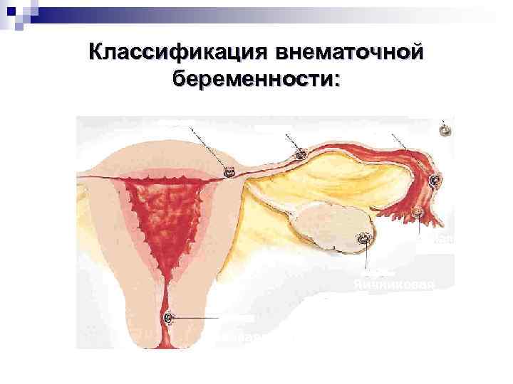 Классификация внематочной беременности: Интерстициальная Истмическая Ампулярная Фимбриальная Яичниковая Шеечная 