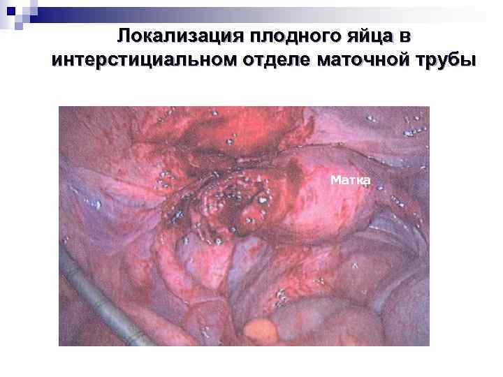 Локализация плодного яйца в интерстициальном отделе маточной трубы Матка 