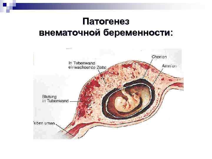 Патогенез внематочной беременности: 