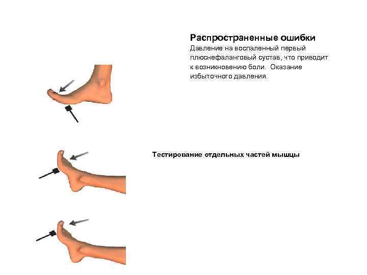 Распространенные ошибки Давление на воспаленный первый плюснефаланговый сустав, что приводит к возникновению боли. Оказание