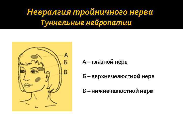 Невралгия тройничного нерва Туннельные нейропатии А – глазной нерв Б – верхнечелюстной нерв В