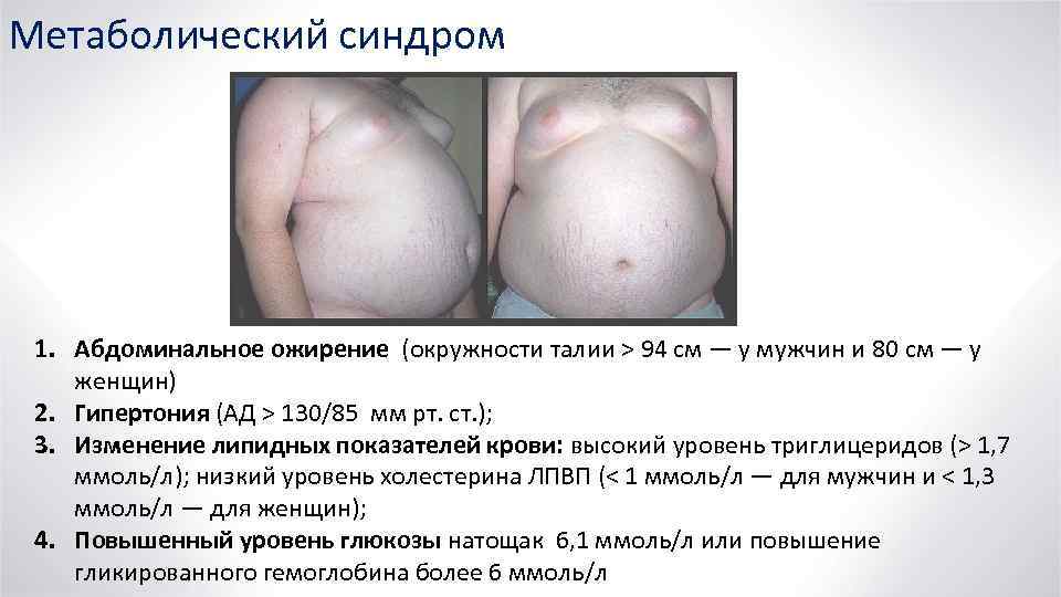 Метаболический синдром 1. Абдоминальное ожирение (окружности талии > 94 см — у мужчин и