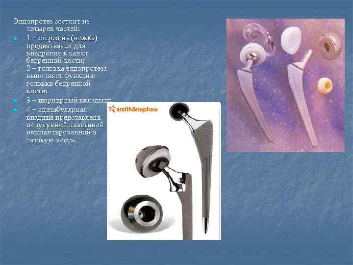 Эндопротез состоит из четырех частей: n 1 – стержень (ножка) предназначен для внедрения в