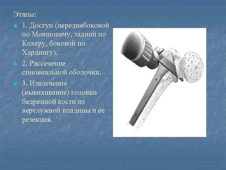 Этапы: n 1. Доступ (переднебоковой по Мовшовичу, задний по Кохеру, боковой по Хардингу). n