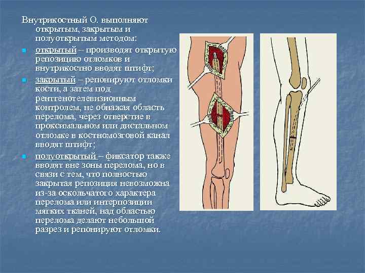 Внутрикостный О. выполняют открытым, закрытым и полуоткрытым методом: n открытый – производят открытую репозицию