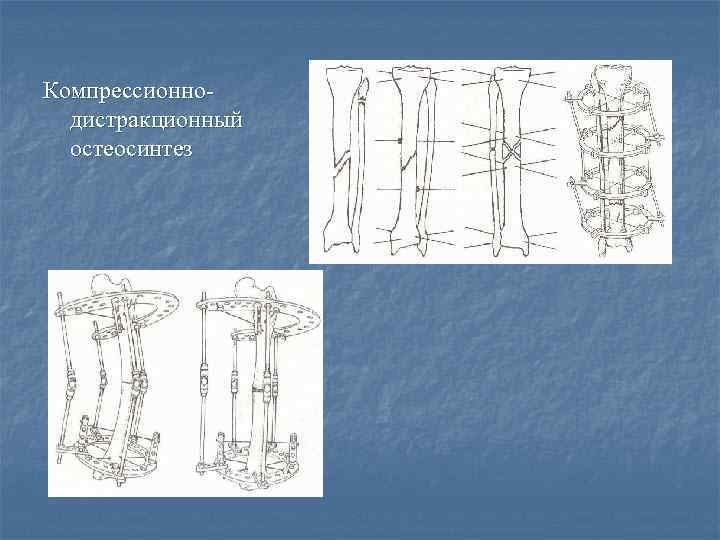 Компрессионнодистракционный остеосинтез 