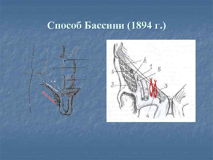 Бассини при бедренной грыже. Пластика пахового канала по Бассини.