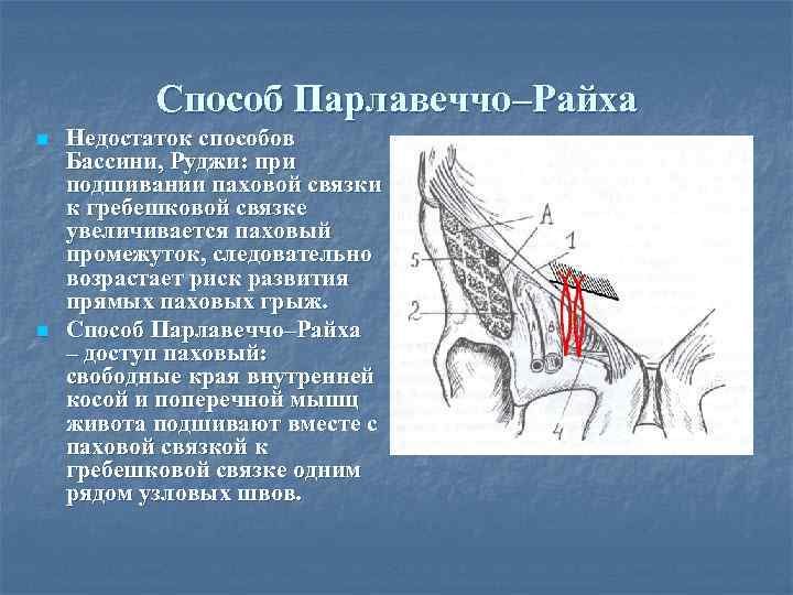 Способ Парлавеччо–Райха n n Недостаток способов Бассини, Руджи: при подшивании паховой связки к гребешковой