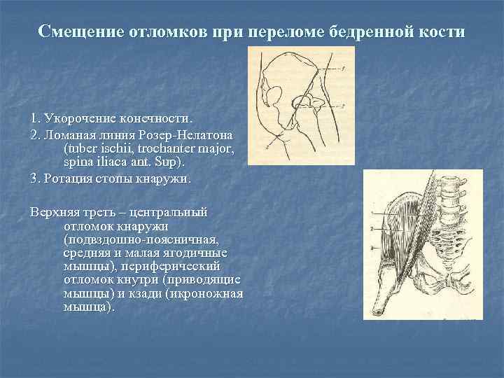 Смещение отломков при переломе бедренной кости 1. Укорочение конечности. 2. Ломаная линия Розер-Нелатона (tuber