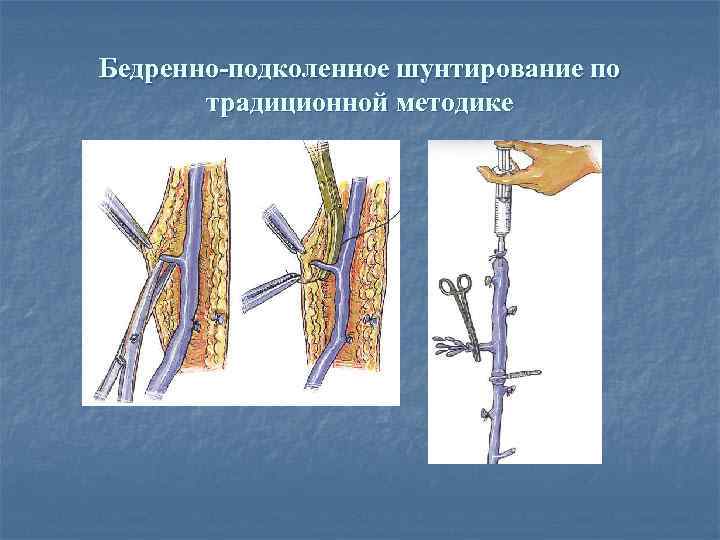 Бедренно-подколенное шунтирование по традиционной методике 