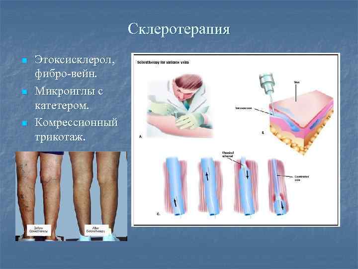 Склеротерапия n n n Этоксисклерол, фибро-вейн. Микроиглы с катетером. Комрессионный трикотаж. 