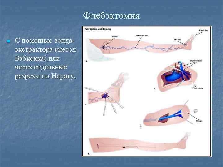 Флебэктомия n С помощью зондаэкстрактора (метод Бэбкокка) или через отдельные разрезы по Нарату. 