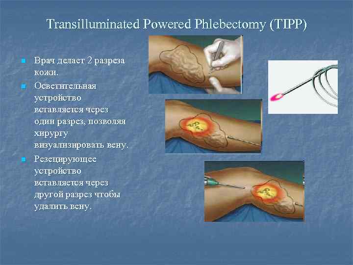 Transilluminated Powered Phlebectomy (TIPP) n n n Врач делает 2 разреза кожи. Осветительная устройство