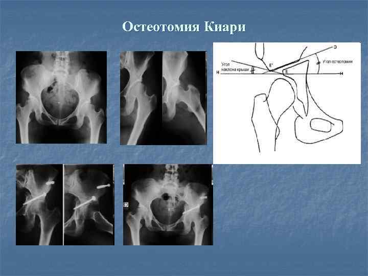 Остеотомия Киари 