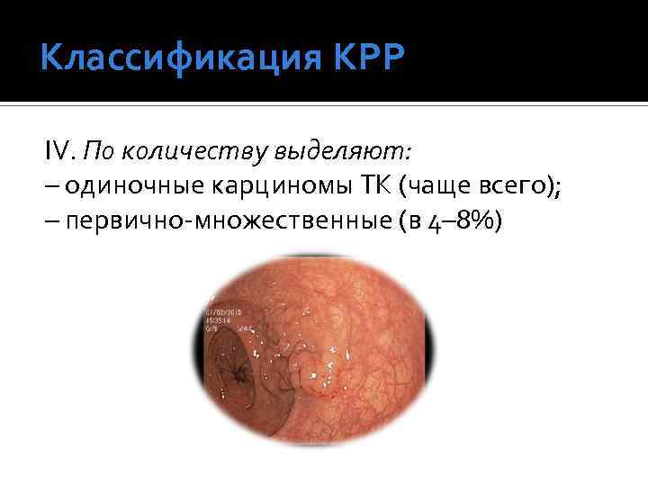 Классификация КРР IV. По количеству выделяют: – одиночные карциномы ТК (чаще всего); – первично-множественные