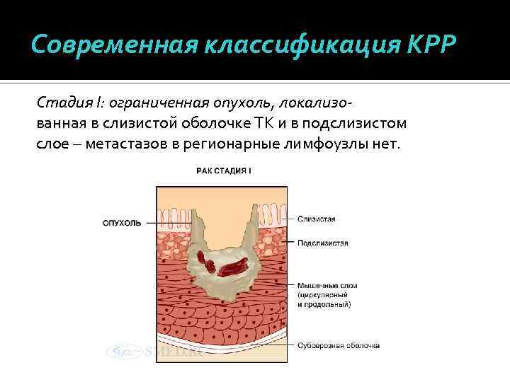 Современная классификация КРР Стадия I: ограниченная опухоль, локализованная в слизистой оболочке ТК и в